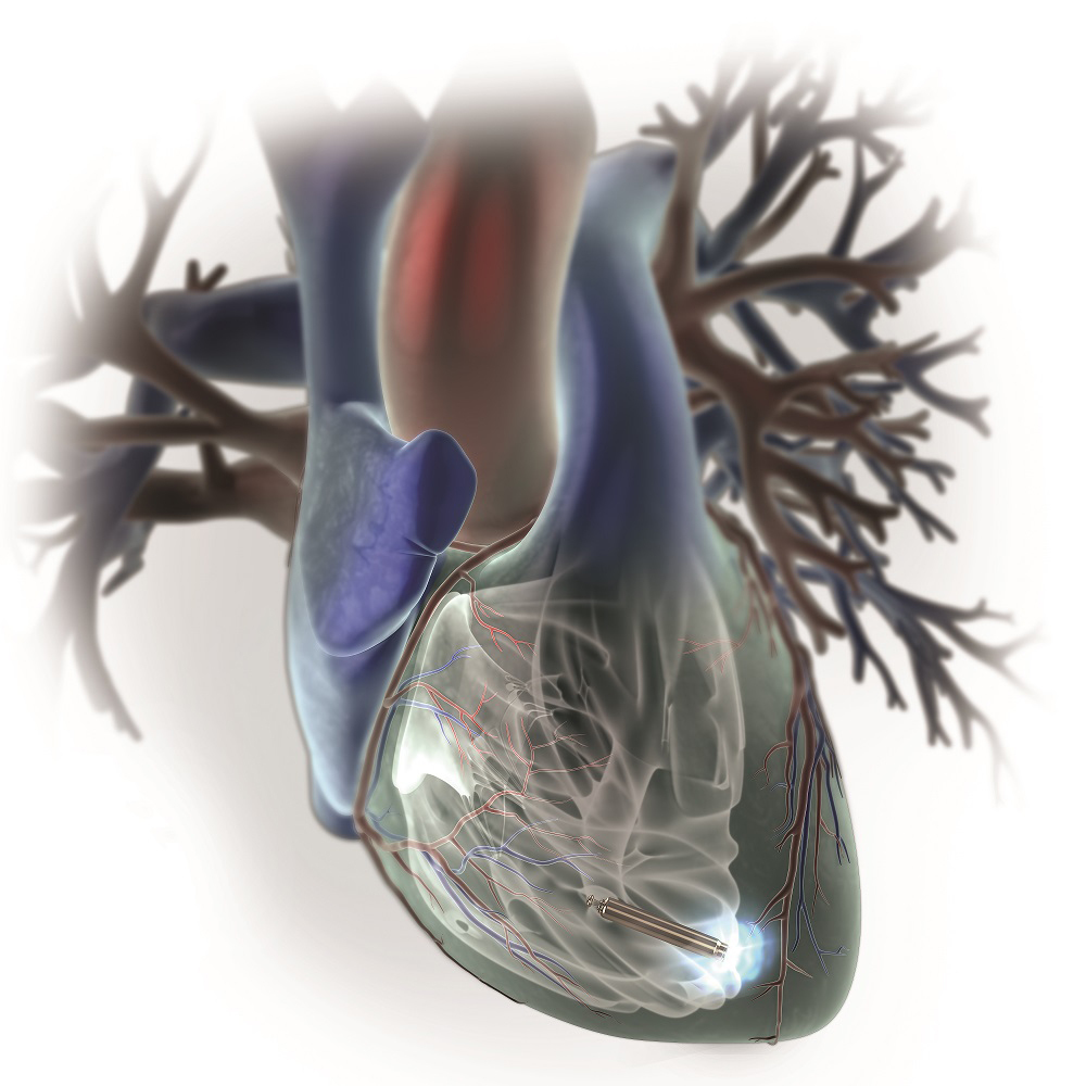 Among the innovative products that make St. Jude Medical such an attractive company for Abbott to acquire is its Nanostim implant for arrhythmia management.